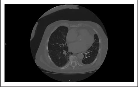 Figure 2 From A Rare Case Of Simultaneous Pneumoperitoneum And
