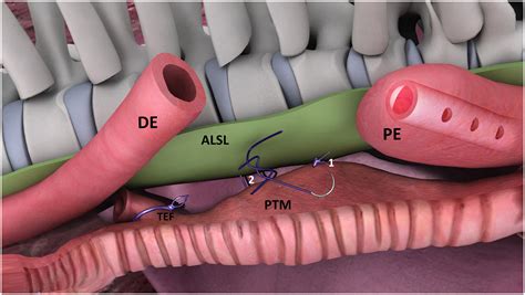 thoracoscopic posterior tracheopexy during primary esophageal atresia repair a new approach to