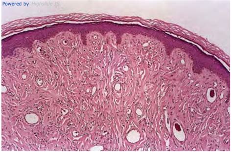 Pathology Outlines Angiofibroma Fibrous Papule