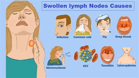 Swollen Lymph Nodes Locations