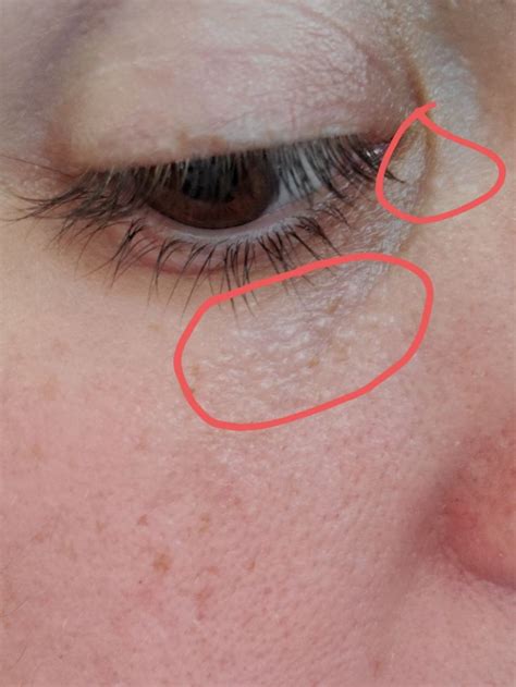 Under Eye Bumps Not Milia Undereye Skin Dry Skin Under Eyes Skin Bumps