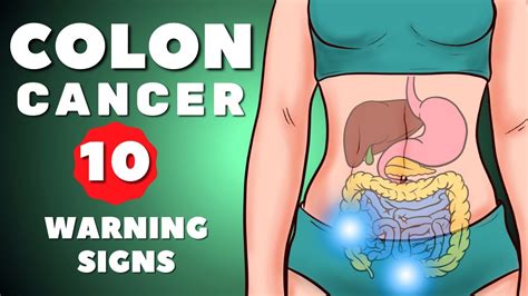 Colon Cancer Symptoms Colorectal Cancer Warning Signs Of Colon Cancer Colon Cancer