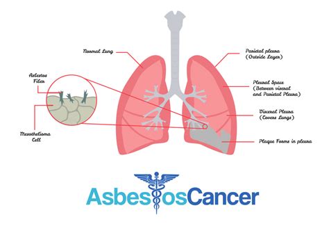 Pin On Mesothelioma And Treatment