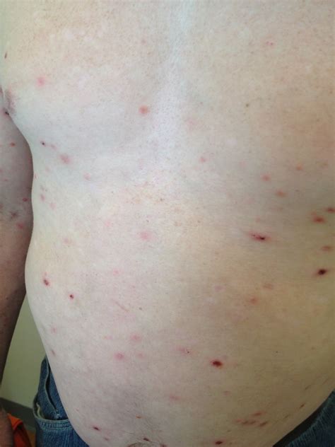 Pruritic Rash On Fifty Year Old Diabetic With Substance Abuse And Other