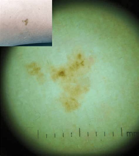 Dermoscopic Image Light Brown Pigmentation And Asymetrically Pigmented