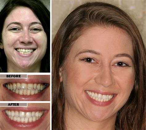 Dental Filling Front Teeth