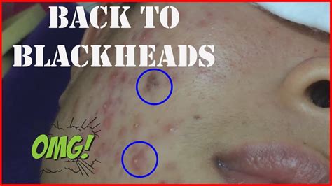 Blackheads Whiteheads Pimples And Cystic Acne Extraction Facial