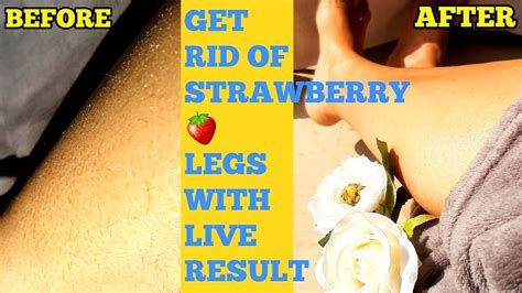 Get Rid Of Strawberry 🍓 Legs In One Daywith Proof Remove Strawberry