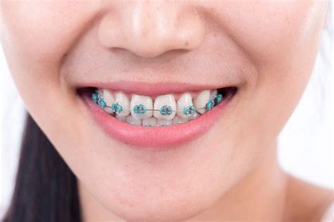 Teeth whitening gels and strips can make teeth and gums more sensitive but less potent ones maybe less effective. How To Whiten Teeth After Using Braces - beautyinfospot