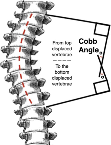 Management Of Scoliosis Advances In Pediatrics