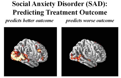 How Brain Imaging Helps Explain Social Anxiety Disorder