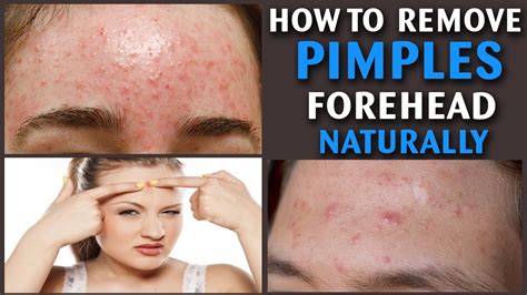 Get Rid Of Bumps On Forehead Get Rid Of Bumps Vrogue Co