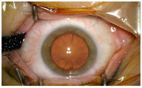 Medicina Free Full Text Cataract Surgery After Radial Keratotomy