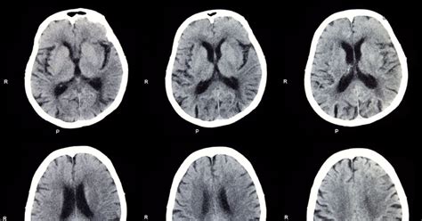 10 Common Brain Diseases Facty Health