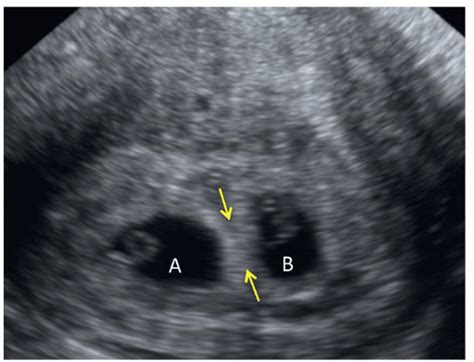 Multiple Pregnancies In The First Trimester Radiology Key