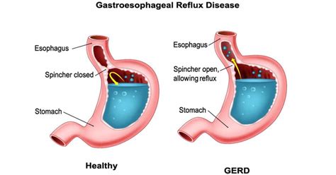 Gerd symptoms can include heartburn or indigestion. What is Gastroesophageal Reflux-GERD? | Great Lakes ...