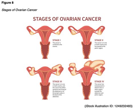 Ovarian Cancer For Aprns Nursing Ce Course Nursingce