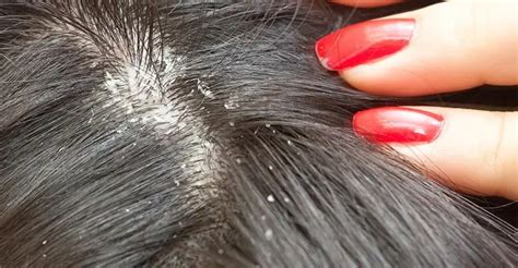 Lice Eggs How To Recognize Them And How To Get Rid Of Them Health 2023