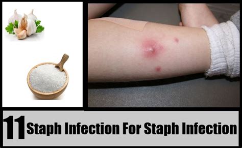 11 Staph Infection Home Remedies Natural Treatments And Cures Search