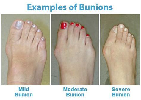 Bunion Causes Symptoms Treatment How To Relief
