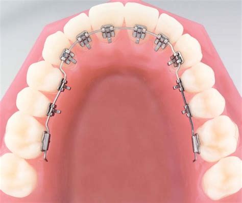 Lingual Fixed Appliance Brentwood Orthodontic And Implant Centre