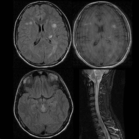 Acute Disseminated Encephalomyelitis Pediatric Radiology Reference