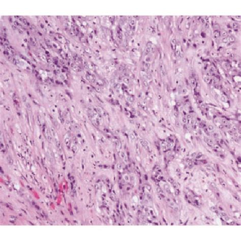 Histologic And Immunophenotypic Features Of Collecting Duct Carcinoma