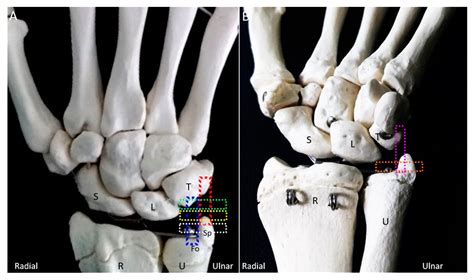 Jcm Free Full Text Ulnar Wrist Pain Revisited Ultrasound Diagnosis