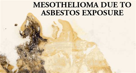 Mesothelioma treatments are available, but for many people with mesothelioma, a cure isn't possible. Mesothelioma Tips | Useful Mesothelioma Information ...