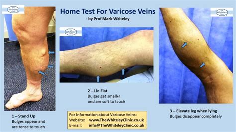 Home Test For Varicose Veins The Whiteley Clinic