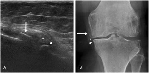 Ultrasonography Of The Late Stage Knee Osteoarthritis Prior To Total