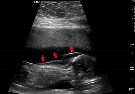 Cystic Hygroma In Fetus And In Adults Causes Prognosis And Treatment