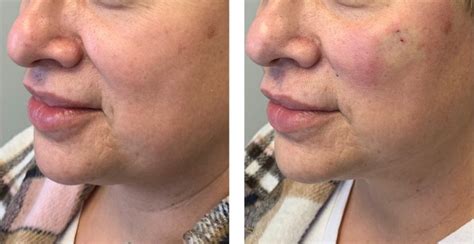 Complete Guide To Face Thread Lifts