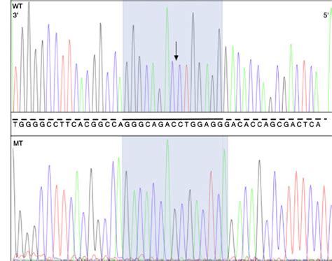 Sequence Traces Of Cloned Flcn Exon 6 Fragments Amplified From Tumour