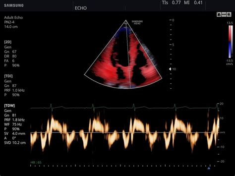 Ultrasound Images • Heart Tissue Doppler Echogramm №791