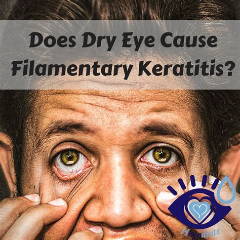 Dry Eye Symptoms Causes Home Remedies And Treatment Of Dry Eyes