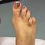 Toe Lengthening Surgery In Leeds  Yorkshire Foot Hospital