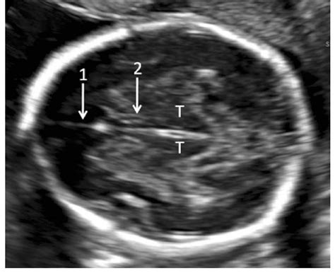Transverse Axial Scan Of Fetal Head At The Level Of Thalami 1 Falx