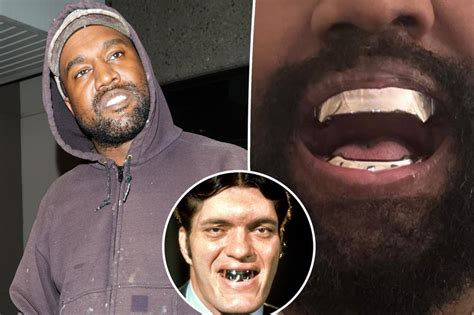 Kanye West Gets 850k Titanium Dentures Modeled After James Bond Spy