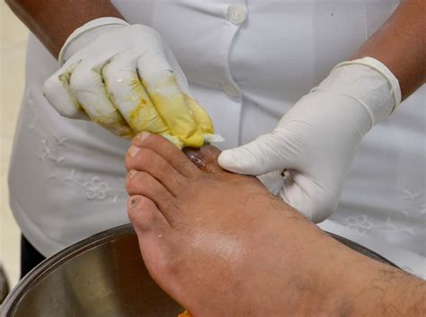 Puede prevenirse el pie diabético con atención oportuna Secretaría de Salud Gobierno