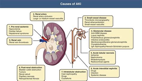Acute Kidney Injury What You Need To Know
