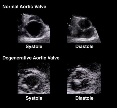 Aortic Valve Sclerosis With Mild Aortic Regurgitation Doctorvisit