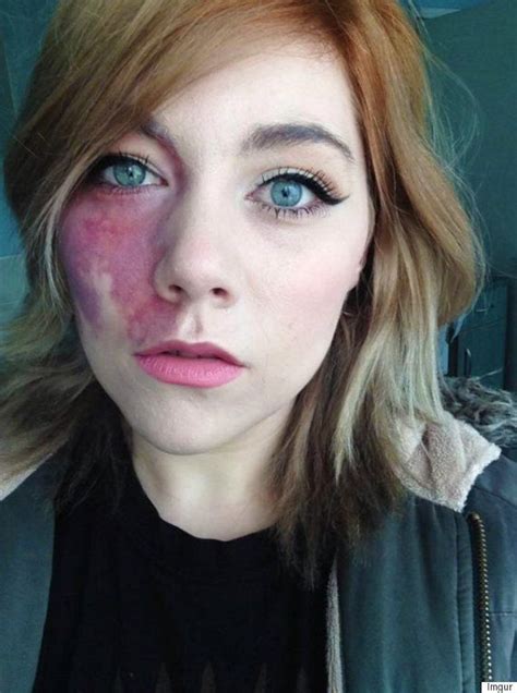 Woman Told She Was Too Ugly To Love And Undateable Proudly Shows Facial Birthmark Shes