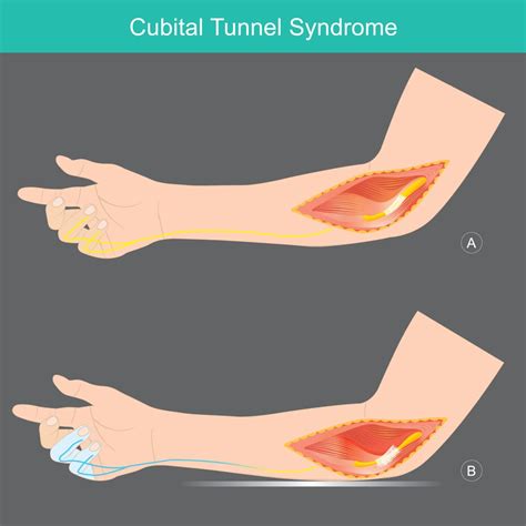 Cubital Tunnel Release Treatment And Recovery