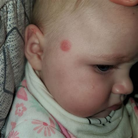 Red Bumps On Head Babycenter