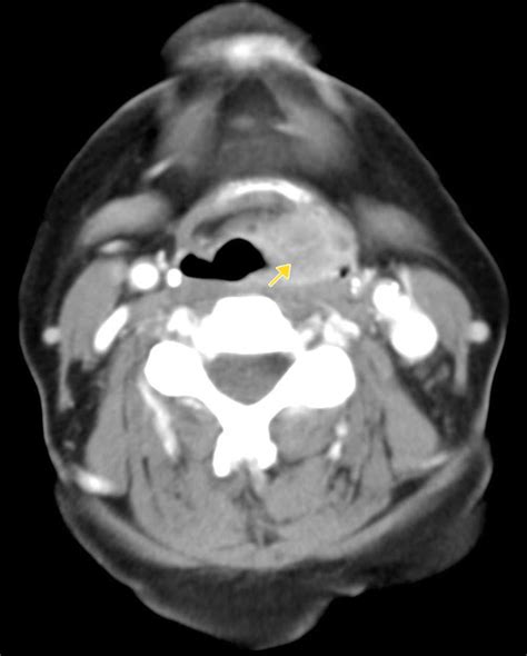 Laryngeal Cancer Staging