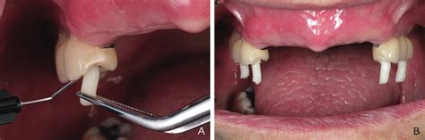 A Luting Composite Resin Marker To Occlusal Surface Of Metal Ceramic