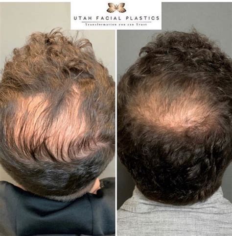 Balding Crown How To Spot It Utah Hair Restoration