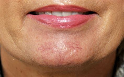Laser For Blue Veins On Face Cosmetic Surgery Tips