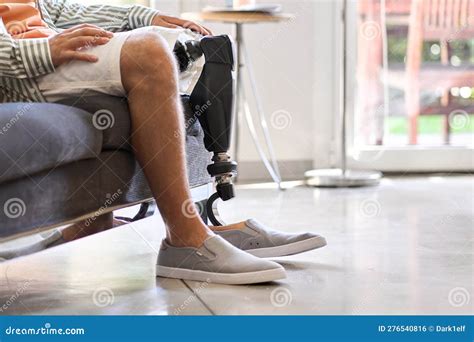 Amputee Man With Above Knee Leg Prosthesis Sitting On Sofa Close Up